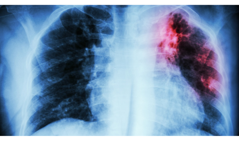 Une radiographie des poumons atteints de tuberculose, montrant la partie supérieure du poumon gauche colorée en rouge.